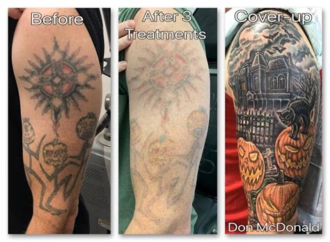 Tattoo Removal in Honolulu