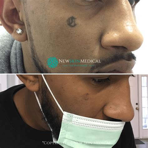 Tattoo Removal in Augusta Ga