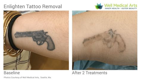 Tattoo Removal in McKinney, TX