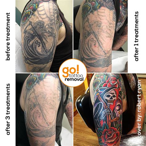 Tattoo removal insurance