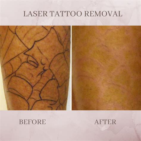 Tattoo removal process