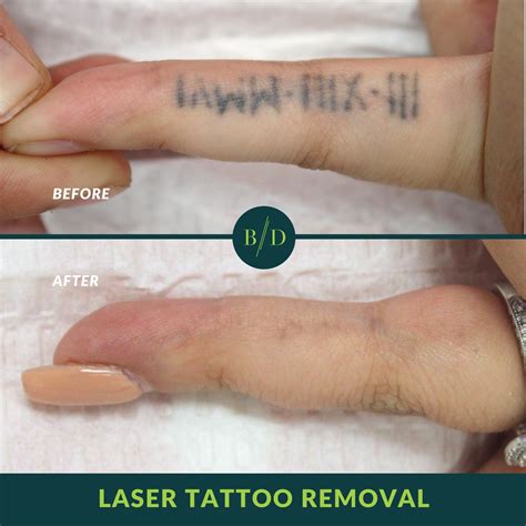 Tattoo removal maintenance