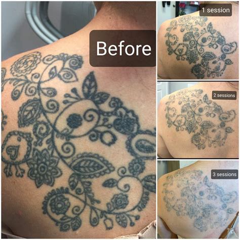 Tattoo removal in Nashville