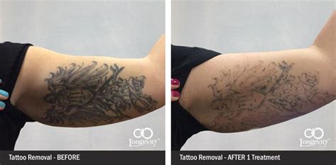 Tattoo removal Okc solutions