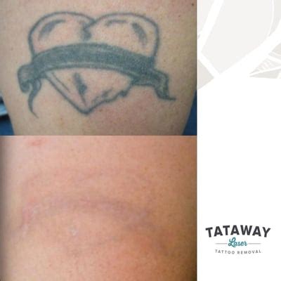 Tattoo removal Philadelphia review