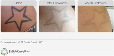 Tattoo removal practitioner