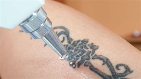 Tattoo removal preparation