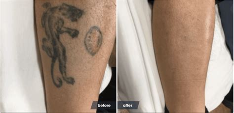 Tattoo removal recovery tips