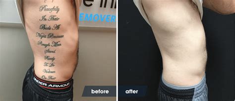 Tattoo removal recovery process