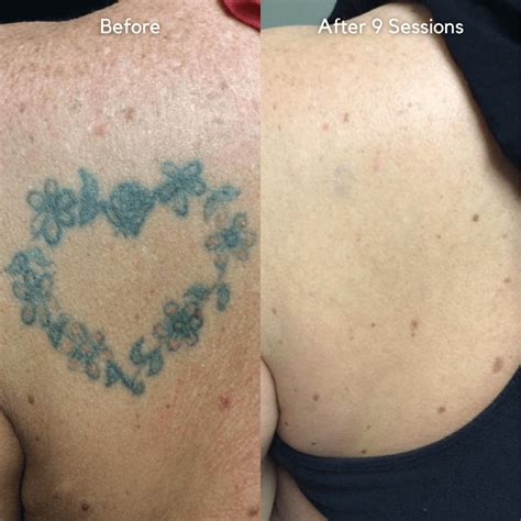 Tattoo removal results