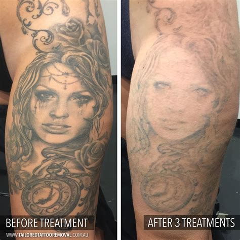 Tattoo removal results before and after