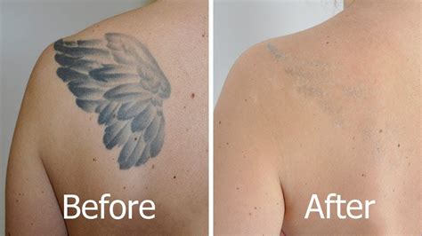 Tattoo removal reviews in Nashville