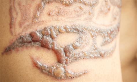 Tattoo removal risks in Philadelphia