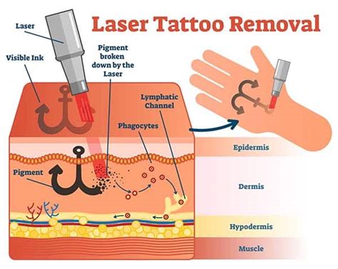 Tattoo removal safety