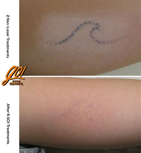 Laser tattoo removal scarring