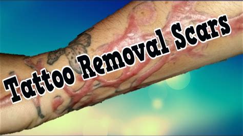 Tattoo removal success