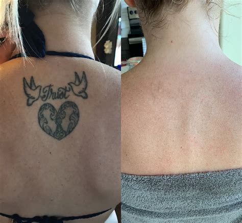 Tattoo removal success