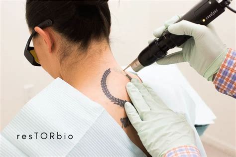 Choosing the right tattoo removal technician