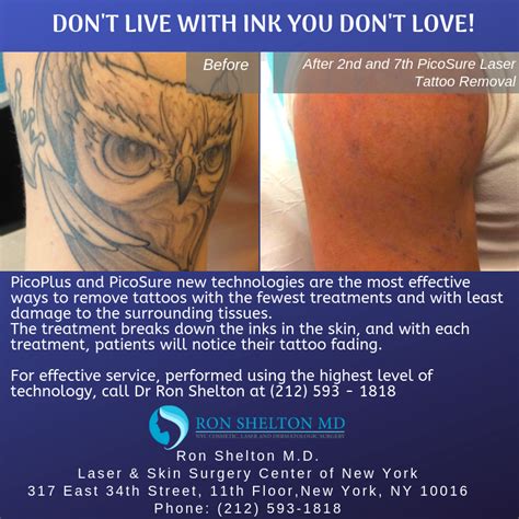 Advanced tattoo removal technologies