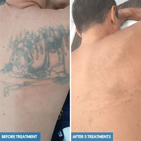 Tattoo removal in Tijuana