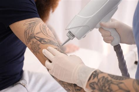 Tattoo removal tips