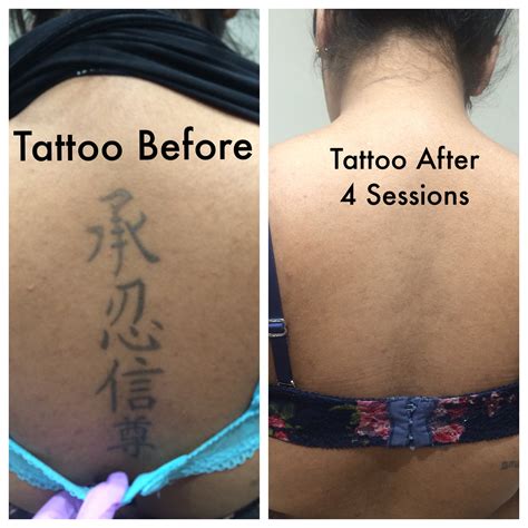 Tattoo removal and correction