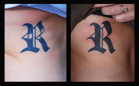 Tattoo repairs