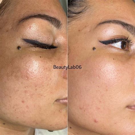 Tattooing over acne scars techniques