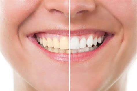 Teeth Whitening Importance