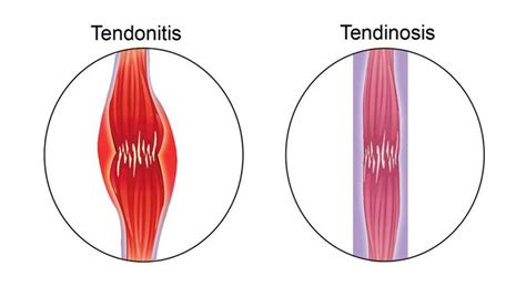 Tendinosis