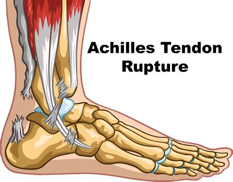 Tendon Rupture