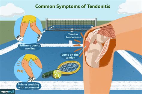 Tendonitis