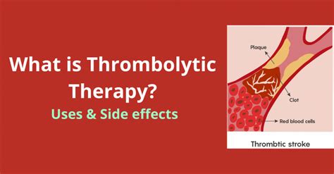 Thrombolytic Therapy