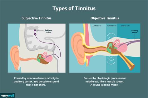 Tinnitus Symptoms