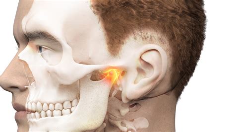 TMJ Ear Pain