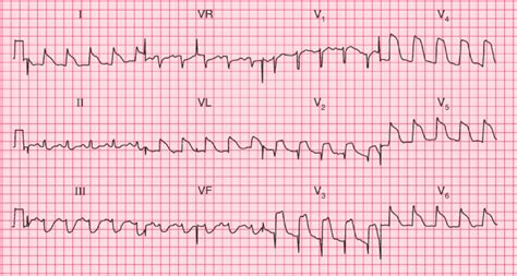 Tombstoning ECG pattern