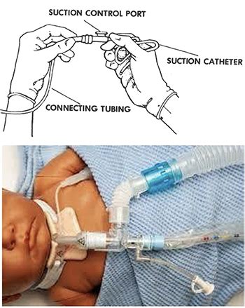 Tracheostomy suctioning process