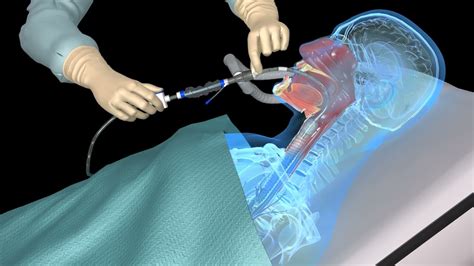 Tracheostomy suctioning catheter