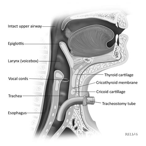 Tracheostomy tube insertion