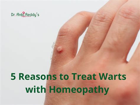 Treating warts with homeopathic remedies