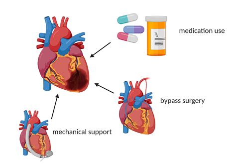 Treatment of Heart Failure