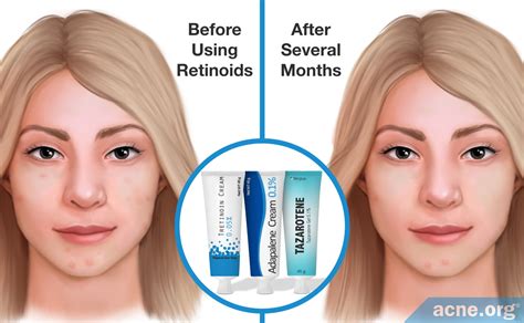 Tretinoin acne treatment