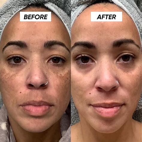 Tretinoin before and after results