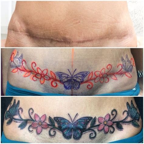 Tummy Tuck Scar Tattoo Coverup Procedure