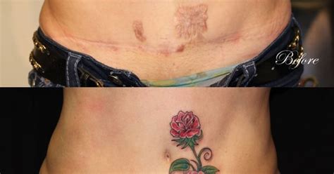 Tummy Tuck Scar Tattoo Aftercare