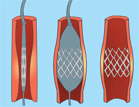 Types of Extraction Clot Removal