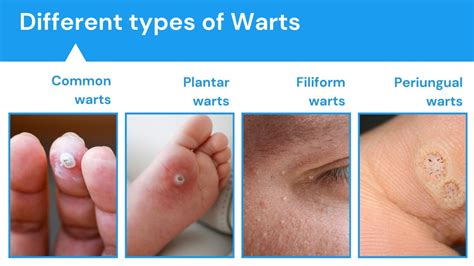 Types of Warts Image