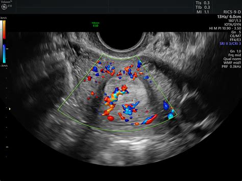 Ultrasound Image