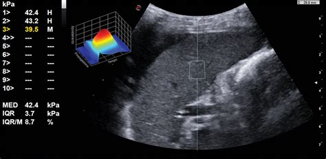 Ultrasound Images