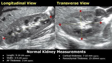 Ultrasound Measurement